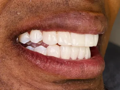 Diseno de Sonrisa en Resina