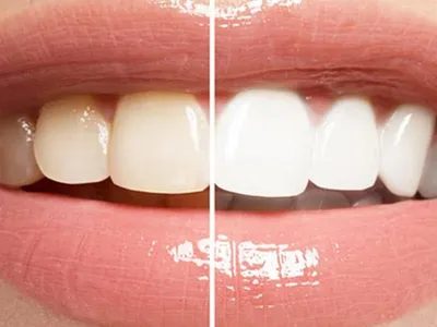 Blanqueamiento Dental