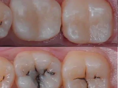 Restauracion de Caries