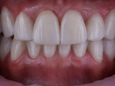 Diseno de Sonrisa en Resina