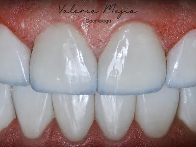 Carillas Dentales de Porcelana